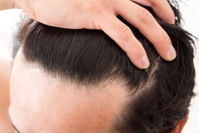育毛剤は、生え際の薄毛対策に効果があるの？