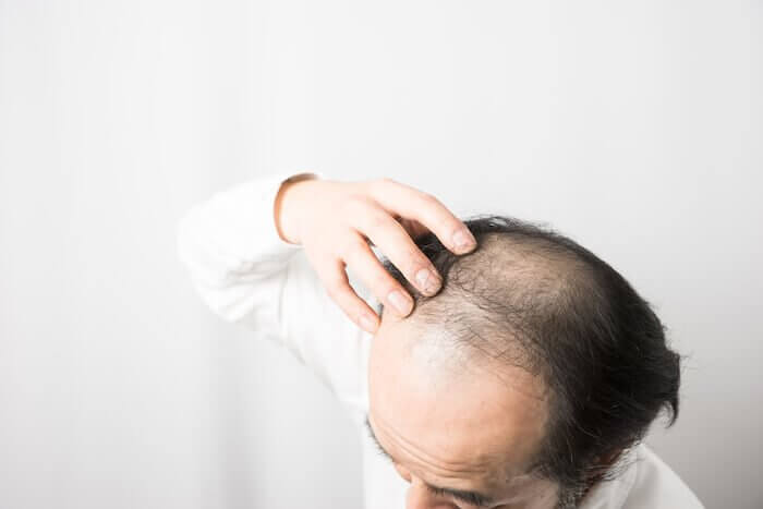 AGA （男性型脱毛症）とは？知っておきたい原因・予防対策・治療法のすべて